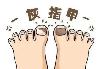 为什么会年纪轻轻就得灰指甲