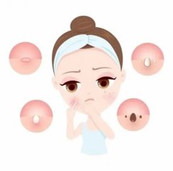 青春痘印如何有效去除